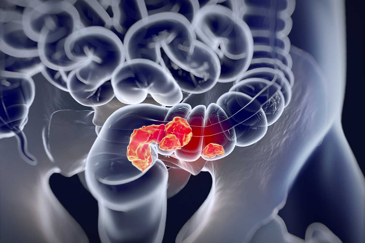 Why Are Colorectal Cancer Cases Increasing?